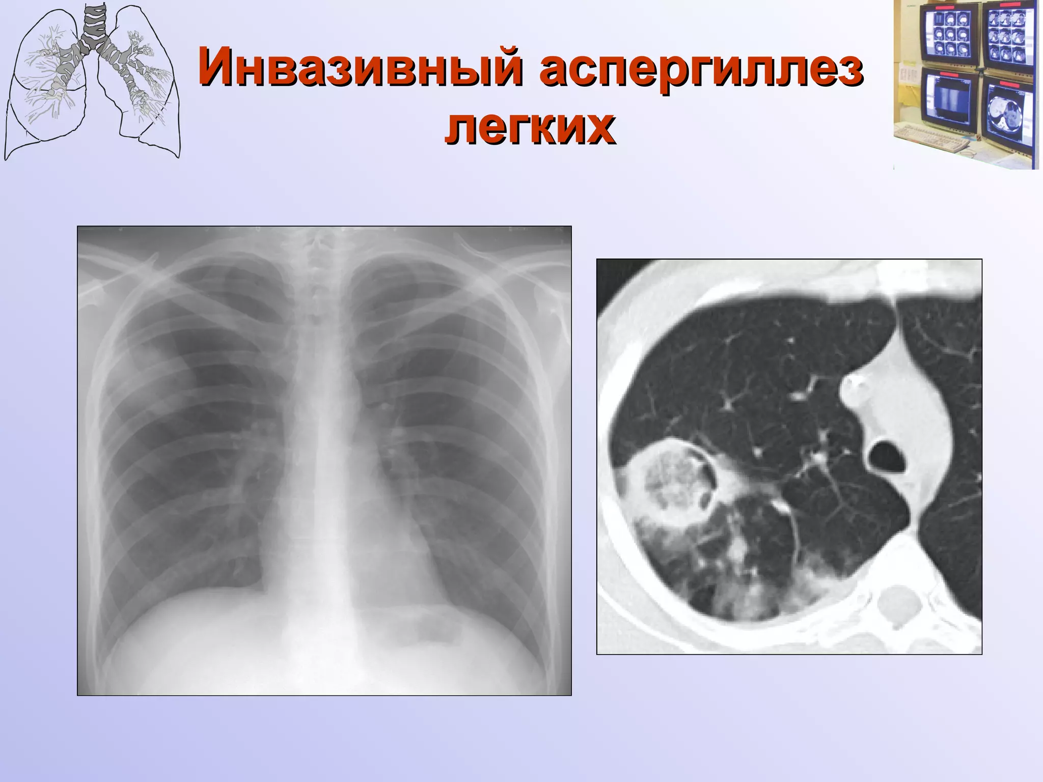 Инвазивный аспергиллез легких 