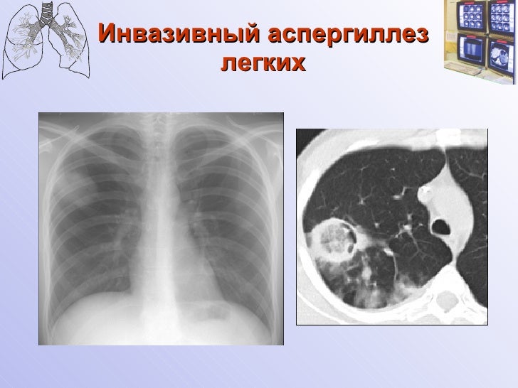 рентгенологические особенности нозокомиальных микозов легких у онколо…