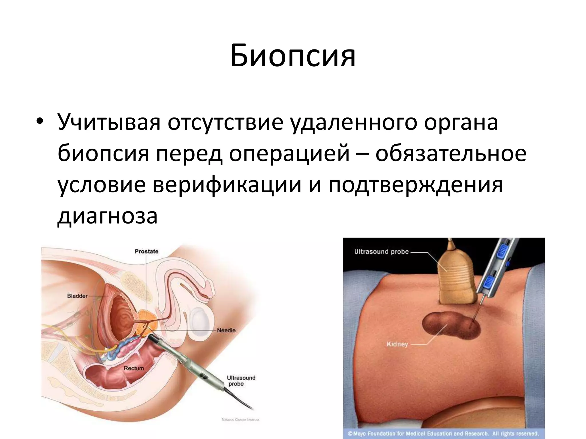 БиопсияУчитывая отсутствие удаленного органа биопсия перед операцией – обязательное условие верификации и подтверждения диагноза