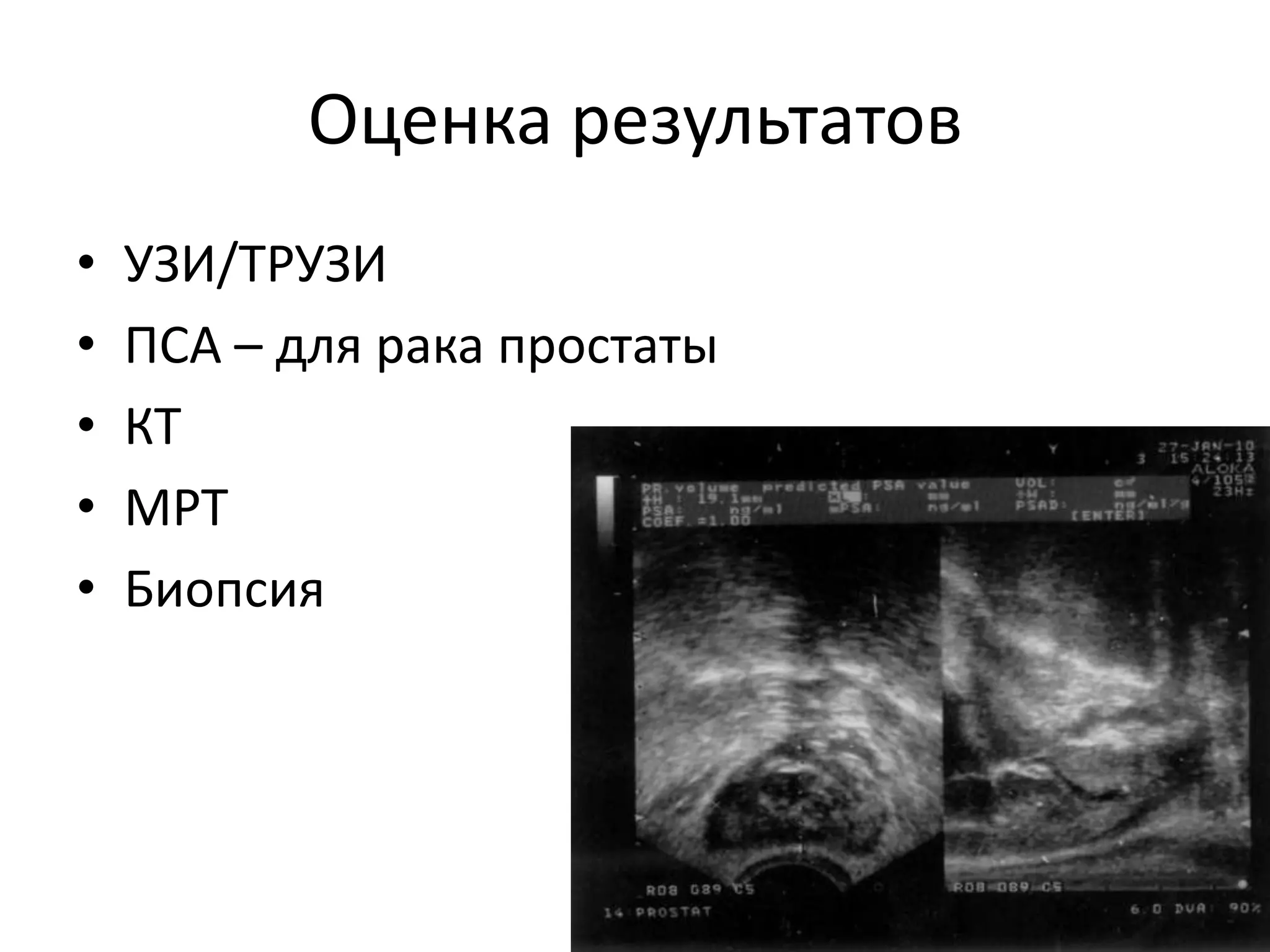 Оценка результатовУЗИ/ТРУЗИПСА – для рака простатыКТМРТБиопсия