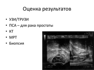 Оценка результатовУЗИ/ТРУЗИПСА – для рака простатыКТМРТБиопсия