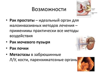 ВозможностиРак простаты – идеальный орган для малоинвазивных методов лечения – применимы практически все методы воздействияРак мочевого пузыряРак почкиМетастазы в забрюшинные Л/У, кости, паренхиматозные органы