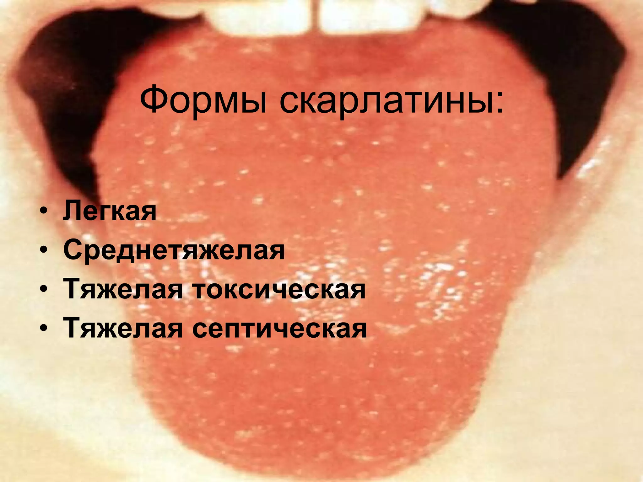 Формы скарлатины: Легкая Среднетяжелая Тяжелая токсическая   Тяжелая септическая   