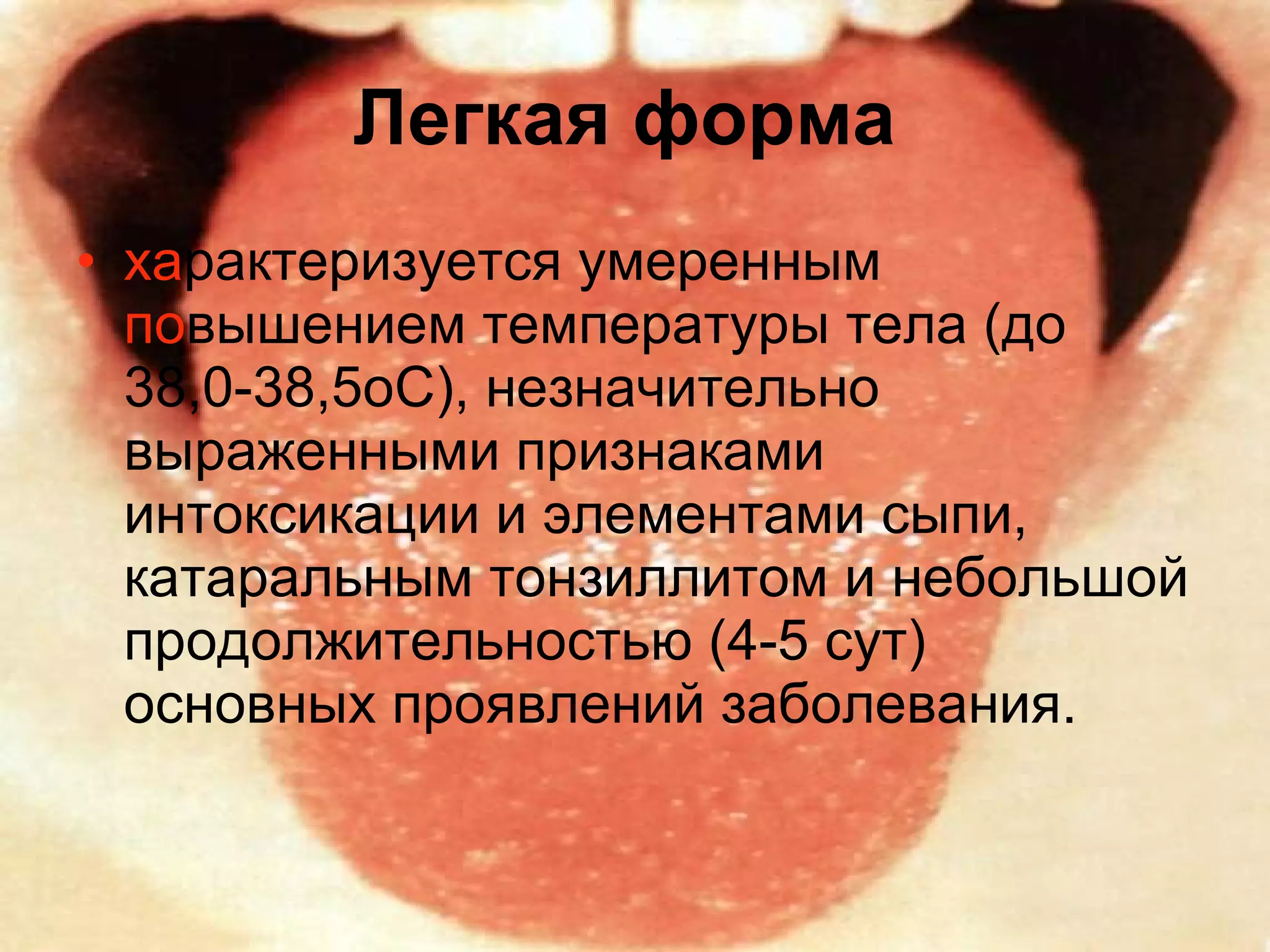 Легкая форма   ха рактеризуется умеренным  по вышением температуры тела (до 38,0-38,5оС), незначительно выраженными признаками интоксикации и элементами сыпи, катаральным тонзиллитом и небольшой продолжительностью (4-5 сут) основных проявлений заболевания. 