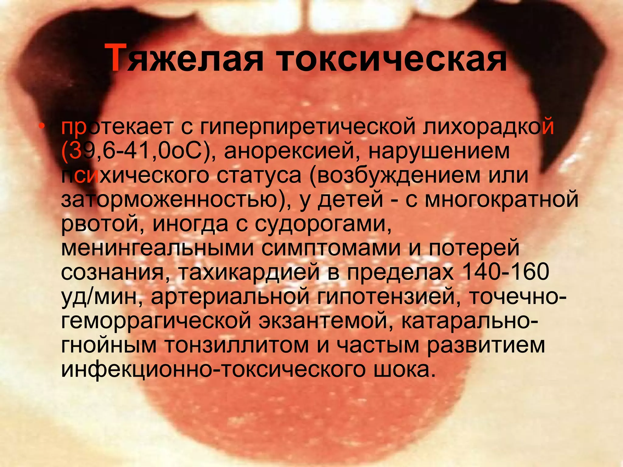 Т яжелая токсическая   пр отекает с гиперпиретической лихорадко й   (3 9,6-41,0оС), анорексией, нарушением п си хического статуса (возбуждением или заторможенностью), у детей - с многократной рвотой, иногда с судорогами, менингеальными симптомами и потерей сознания, тахикардией в пределах 140-160 уд/мин, артериальной гипотензией, точечно-геморрагической экзантемой, катарально-гнойным тонзиллитом и частым развитием инфекционно-токсического шока. 