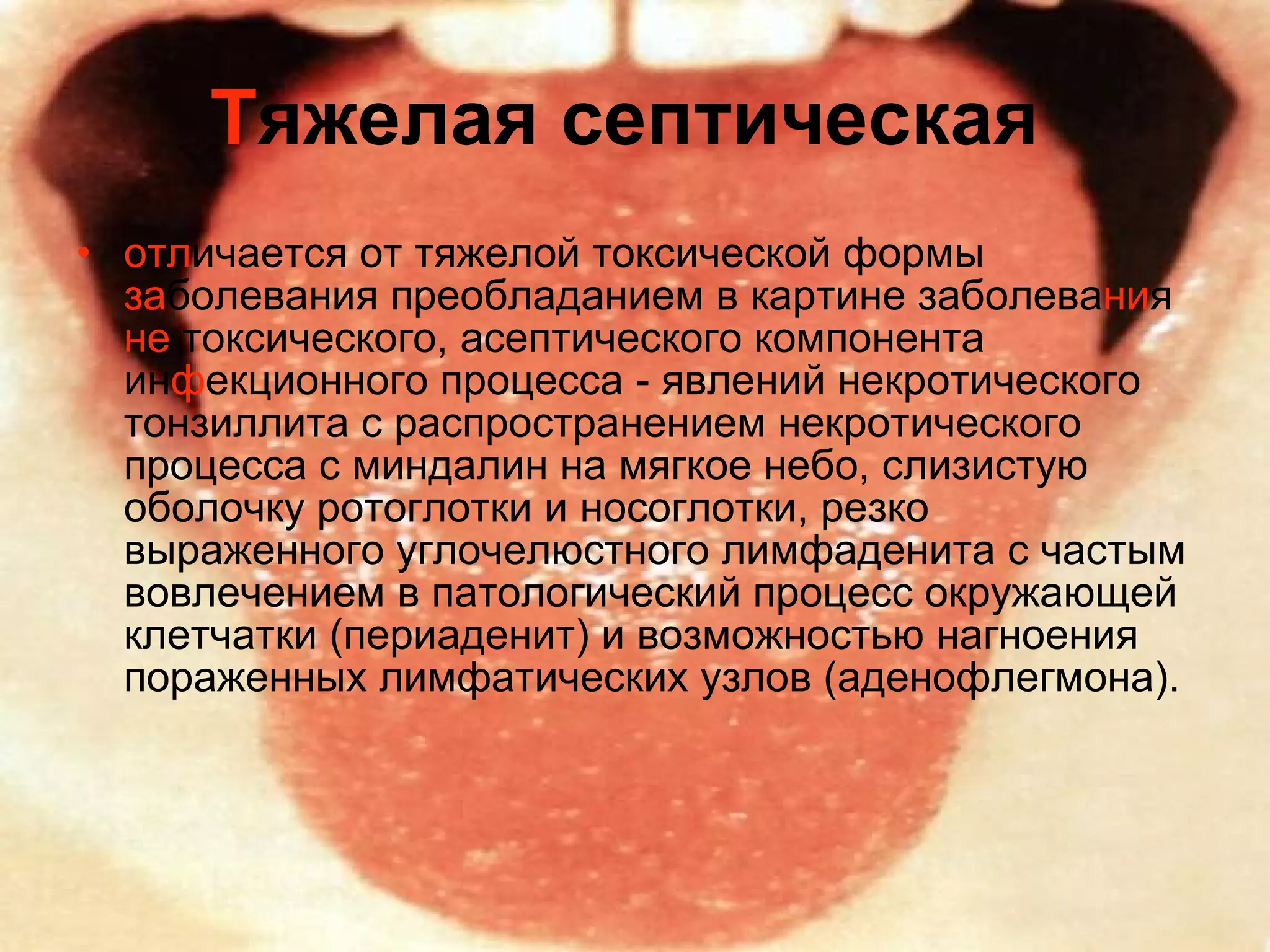 Т яжелая септическая   отл ичается от тяжелой токсической формы  за болевания преобладанием в картине заболева ни я  не  токсического, асептического компонента ин ф екционного процесса - явлений некротического тонзиллита с распространением некротического процесса с миндалин на мягкое небо, слизистую оболочку ротоглотки и носоглотки, резко выраженного углочелюстного лимфаденита с частым вовлечением в патологический процесс окружающей клетчатки (периаденит) и возможностью нагноения пораженных лимфатических узлов (аденофлегмона).  