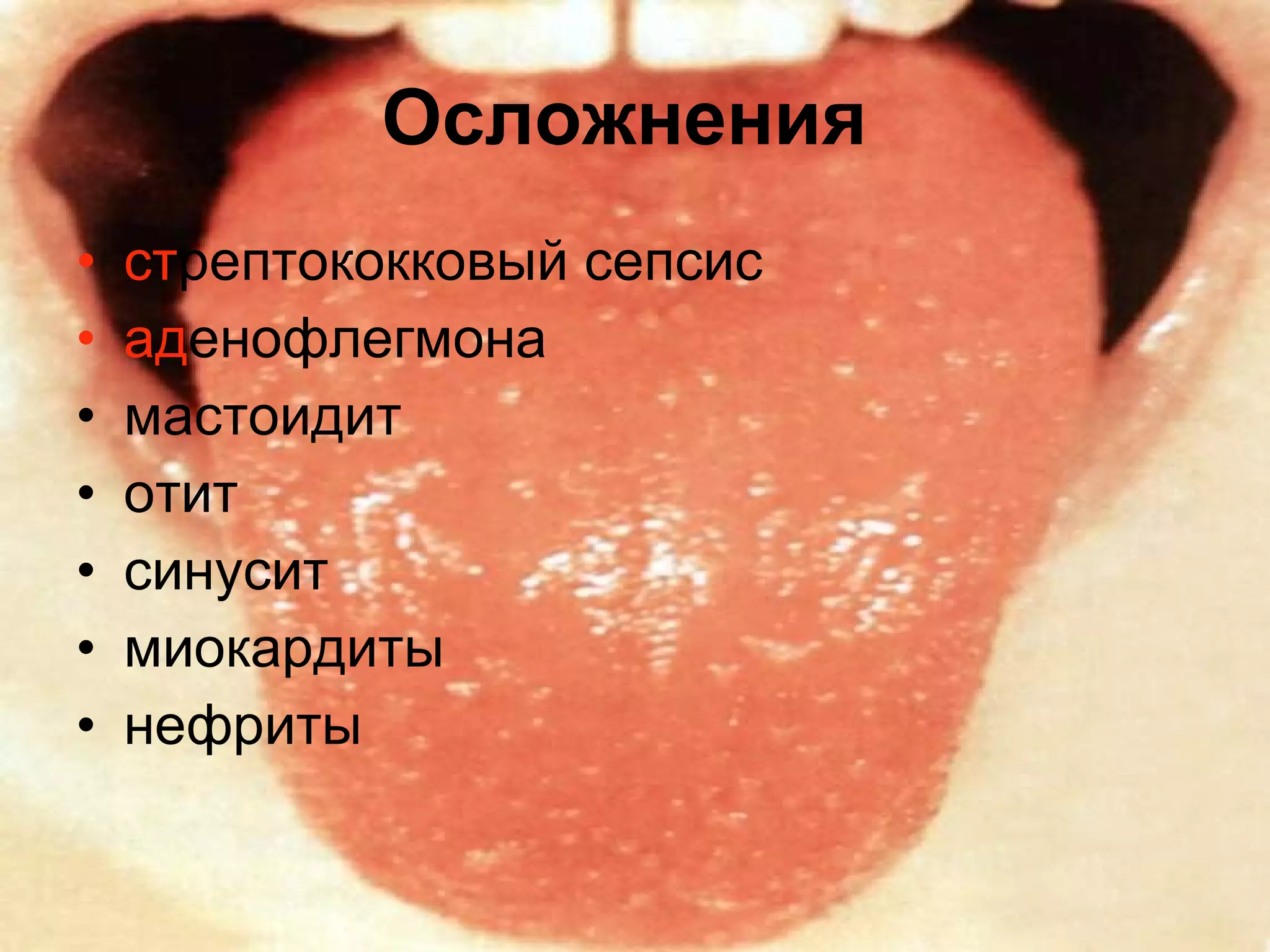 Осложнения   ст рептококковый сепсис ад енофлегмона  мастоидит  отит  синусит  миокардиты  нефриты  