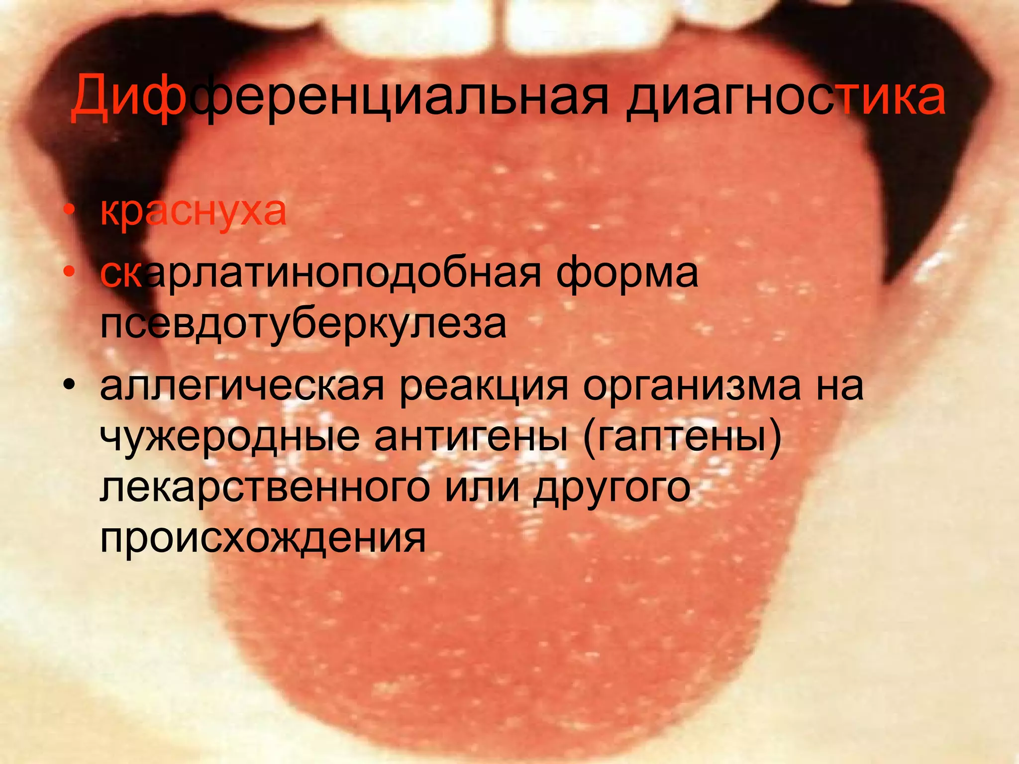 Диф ференциальная диагнос тика краснуха ск арлатиноподобная форма псевдотуберкулеза  аллегическая реакция организма на чужеродные антигены (гаптены) лекарственного или другого происхождения  