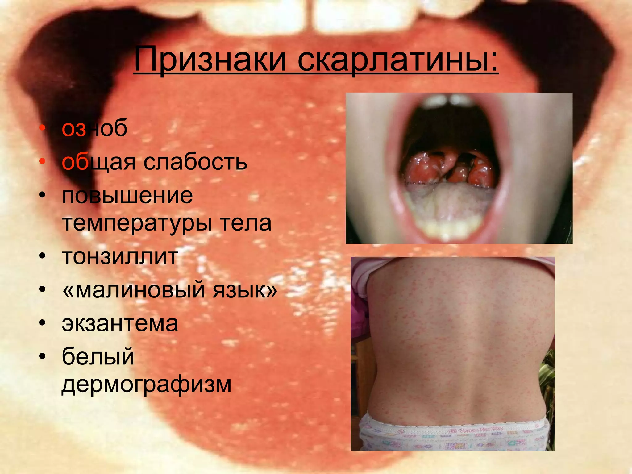 Признаки скарлатины: оз ноб об щая слабость  повышение температуры тела тонзиллит «малиновый язык» экзантема  белый дермографизм 