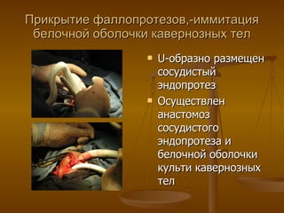 Прикрытие фаллопротезов,-иммитация белочной оболочки кавернозных тел U -образно размещен сосудистый эндопротез Осуществлен анастомоз сосудистого эндопротеза и белочной оболочки культи кавернозных тел 