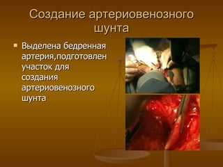 Создание артериовенозного шунта Выделена бедренная артерия,подготовлен участок для создания артериовенозного шунта 
