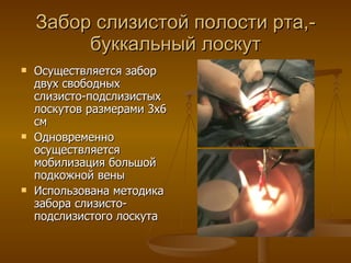 Забор слизистой полости рта,-буккальный лоскут Осуществляется забор двух свободных слизисто-подслизистых лоскутов размерами 3х6 см Одновременно осуществляется мобилизация большой подкожной вены Использована методика забора слизисто-подслизистого лоскута 