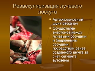 Реваскуляризация лучевого лоскута Артериовенозный шунт рассечен Осуществлен анастомоз между лучевыми сосудами и бедренными сосудами посредством ранее  созданного шунта за счет сегмента аутовены 
