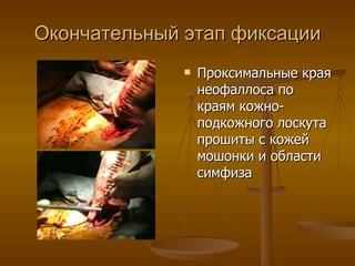 Окончательный этап фиксации Проксимальные края неофаллоса по краям кожно-подкожного лоскута прошиты с кожей мошонки и области симфиза 