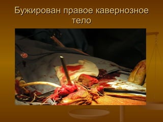 Бужирован правое кавернозное тело 