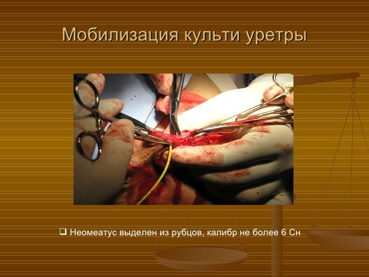 Как увеличить пенис без хирурга