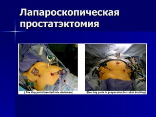 Лапароскопическая простатэктомия 