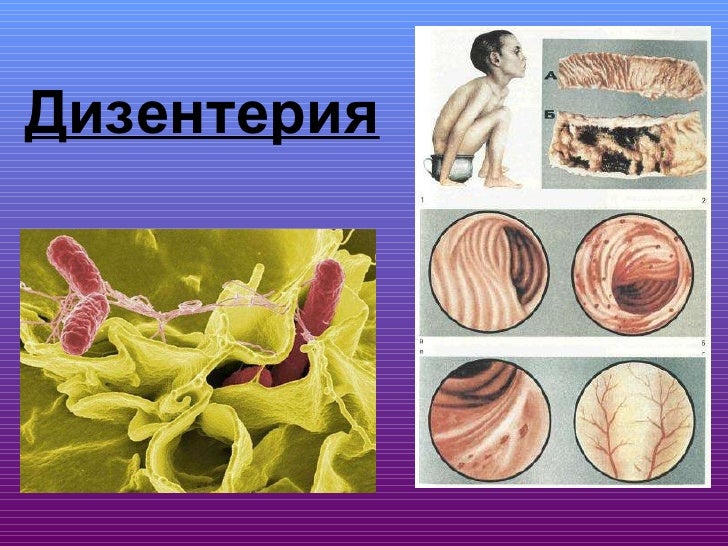Дизентерия это оки
