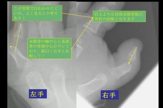 左手 右手 末節骨の軸中心と基節骨の骨頭中心がズレており、脱臼！右手と比較して！ この写真ではわかりにくいが、よく見ると小骨片あり！ 以上より左母指末節骨脱臼骨折の診断となります 