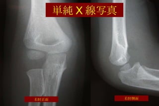 単純 X 線写真 右肘正面 右肘側面 