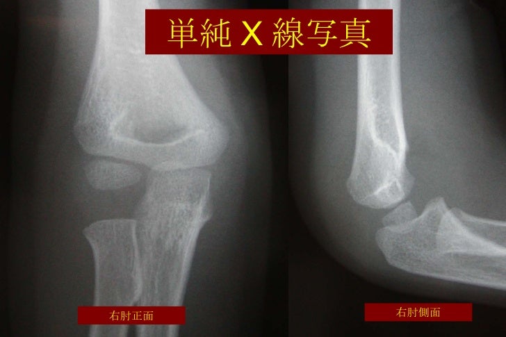 整形外科プライマリーケア 小児外傷
