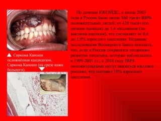 По данным ЮНЭЙДС, в конце 2003 года в России было около 860 тысяч ВИЧ-положительных людей: от 420 тысяч (по низким оценкам) до 1,4 миллионов (по высоким оценкам), что составляет от 0,6 до 1,9% взрослого населения. Недавние исследования Всемирного Банка показали, что, если в России сохранятся тенденции развития эпидемии, которые наблюдались в 1999-2001 гг., к 2010 году ВИЧ-положительными могут оказаться миллион россиян, что составит 10% взрослого населения. Саркома Капоши осложнённая кандидозом.  Саркома Капоши (на срезе кожи больного). 