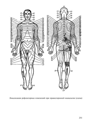 Локализация рефлекторных изменений при правосторонней ишиальгии (схема)




                                                                   251
 