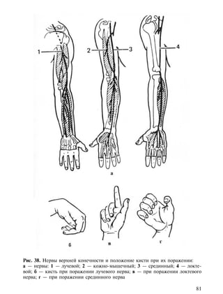 Рис. 38. Нервы верхней конечности и положение кисти при их поражении:
а — нервы: 1 — лучевой; 2 — кожно-мышечный; 3 — срединный; 4 — локте-
вой; б — кисть при поражении лучевого нерва; в — при поражении локтевого
нерва; г — при поражении срединного нерва

                                                                     81
 