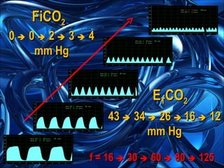FiCO 2 E T CO 2 f = 16    30    60    80    125 0    0    2    3    4 mm Hg 43    34    26     16    12 mm Hg 