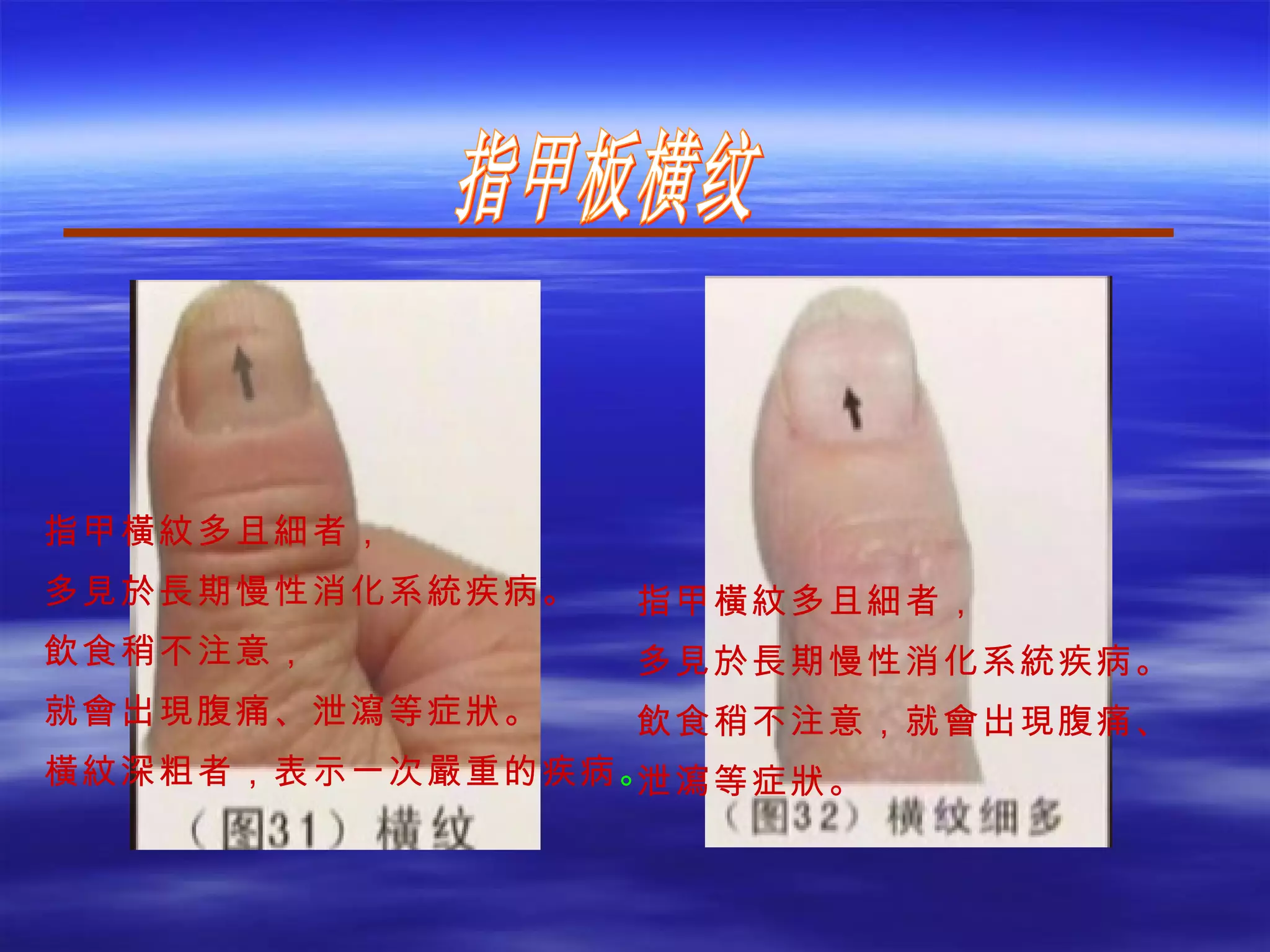 指甲板横纹 指甲橫紋多且細者， 多見於長期慢性消化系統疾病。 飲食稍不注意，就會出現腹痛、 泄瀉等症狀。 指甲橫紋多且細者， 多見於長期慢性消化系統疾病。 飲食稍不注意， 就會出現腹痛、泄瀉等症狀。 橫紋深粗者，表示一次嚴重的疾病 。 