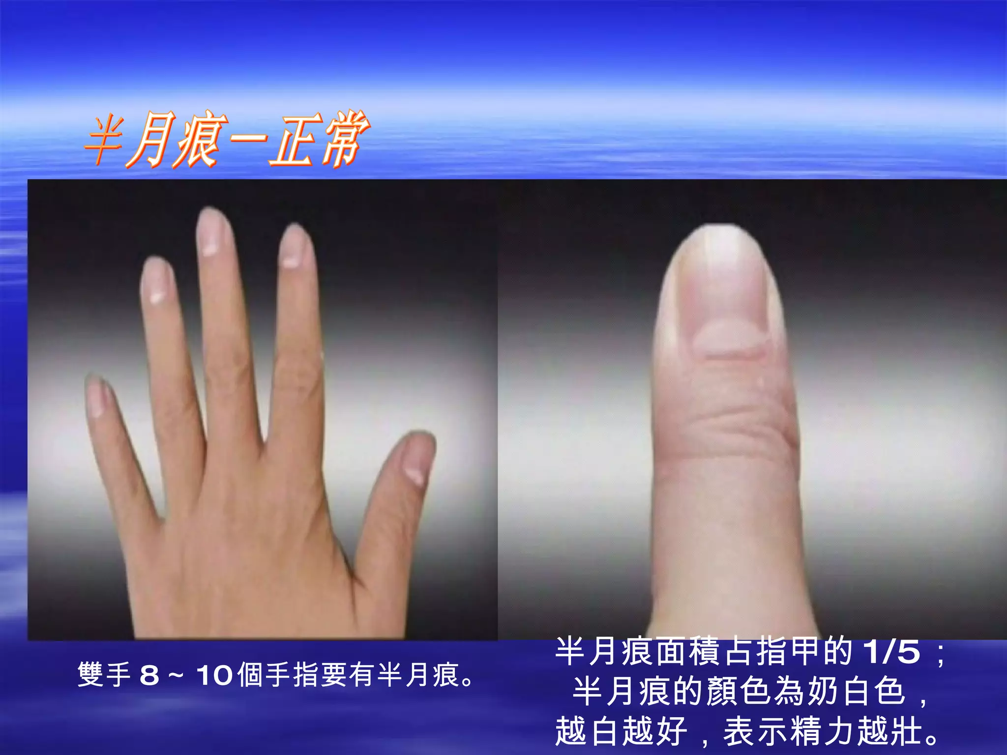 半月痕－正常 半月痕面積占指甲的 1/5 ； 半月痕的顏色為奶白色， 越白越好，表示精力越壯。 雙手 8 ～ 10 個手指要有半月痕。 