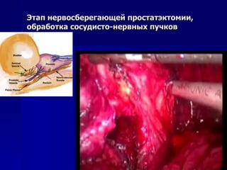 Этап нервосберегающей простатэктомии, обработка сосудисто-нервных пучков 