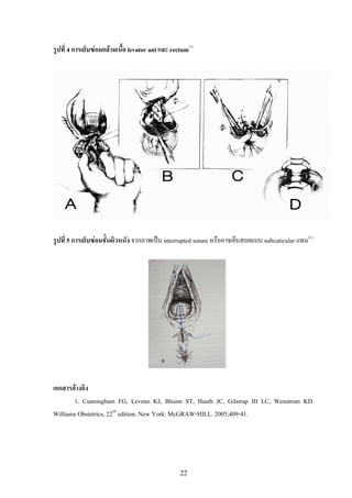รูปที่ 4 การเย็บซอมกลามเนื้อ levator ani และ rectum(1)




รูปที่ 5 การเย็บซอมชั้นผิวหนัง จากภาพเปน interrupted suture...