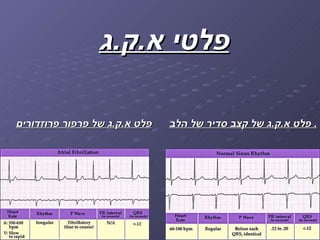 קצב הלב משופר | PPT