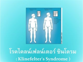 โรคไคลน์เฟลน์เตอร์ ซินโดรม
  ( Klinefelter's Syndrome )
 