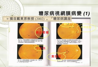糖尿病視網膜病變 (1) 視神經盤 動脈 黃斑部 微血管瘤 小出血 摘自戴東原教授 (2002)  。「糖尿病講座 」 