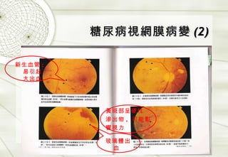 糖尿病視網膜病變 (2) 新生血管 ; 易引起大出血 黃斑部呈硬性 滲出物 ,  可能影 響視力 玻璃體出血 