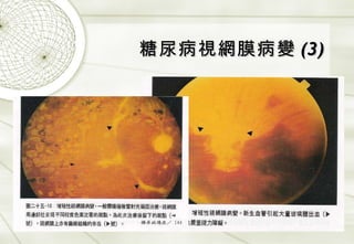 糖尿病視網膜病變 (3) 