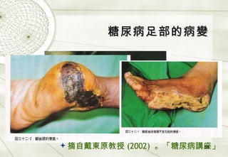糖尿病足部的病變 摘自戴東原教授 (2002)  。「糖尿病講座」 