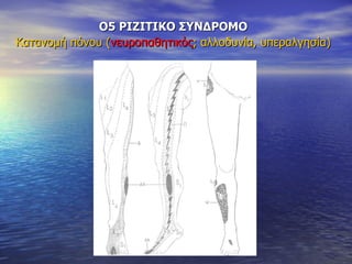 Ο5 ΡΙΖΙΤΙΚΟ ΣΥΝΔΡΟΜΟ Κατανομή πόνου ( νευροπαθητικός ; αλλοδυνία, υπεραλγησία) 