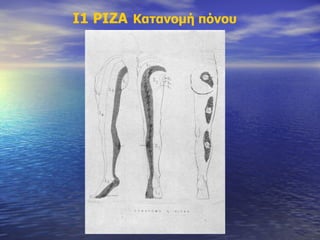 Ι1 ΡΙΖΑ   Κατανομή πόνου 