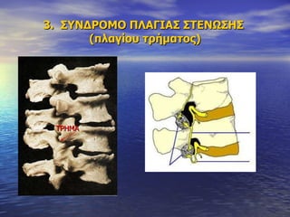 3.  ΣΥΝΔΡΟΜΟ ΠΛΑΓΙΑΣ ΣΤΕΝΩΣΗΣ   (πλαγίου τρήματος) ΤΡΗΜΑ 