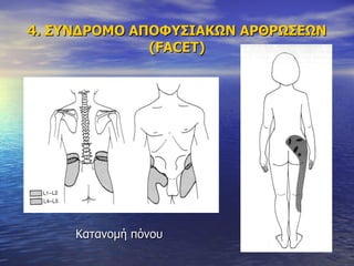 4. ΣΥΝΔΡΟΜΟ ΑΠΟΦΥΣΙΑΚΩΝ ΑΡΘΡΩΣΕΩΝ ( FACET) Κατανομή πόνου 