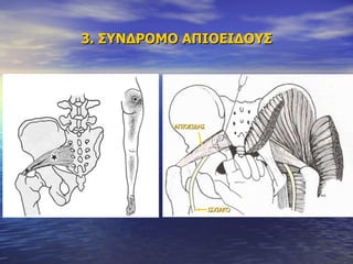 3. ΣΥΝΔΡΟΜΟ ΑΠΙΟΕΙΔΟΥΣ ΑΠΙΟΕΙΔΗΣ ΙΣΧΙΑΚΟ 