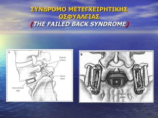 ΣΥΝΔΡΟΜΟ ΜΕΤΕΓΧΕΙΡΗΤΙΚΗΣ ΟΣΦΥΑΛΓΙΑΣ ( THE FAILED BACK SYNDROME ) 