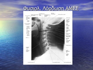 Φυσιολ.   Λόρδωση ΑΜΣΣ 