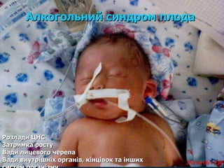 Алкогольний синдром плода Розлади ЦНС Затримка росту Вади лицевого черепа Вади внутрішніх органів, кінцівок та інших систем організму 