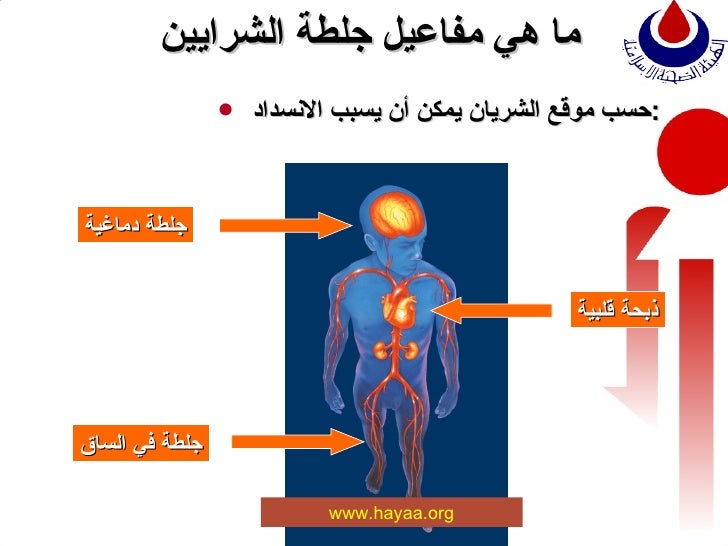 جلطة الشرايين