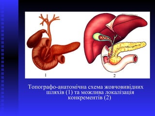 <ul><li>Топографо-анатомічна схема жовчовивідних шляхів (1) та можлива локалізація конкрементів (2)  </li></ul>