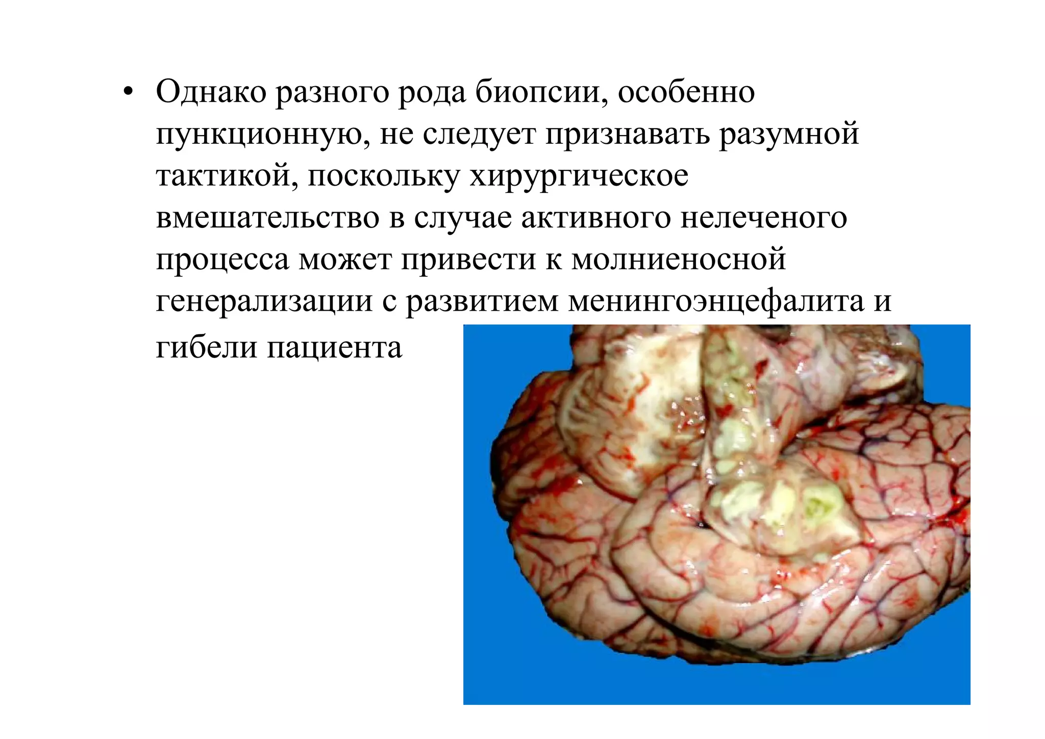 • Однако разного рода биопсии, особенно
  пункционную, не следует признавать разумной
  тактикой, поскольку хирургическое
  вмешательство в случае активного нелеченого
  процесса может привести к молниеносной
  генерализации с развитием менингоэнцефалита и
  гибели пациента
 